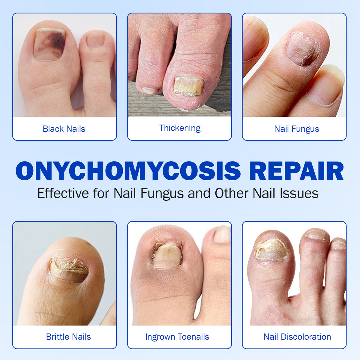 Patchs pour ongles mycosés